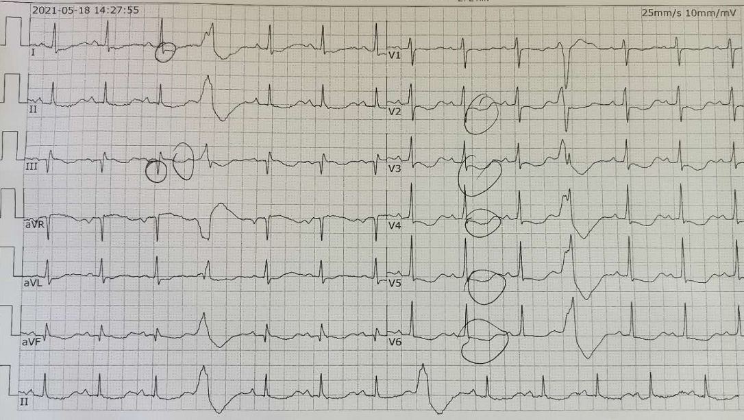 ST-T動態(tài)演變就是冠心病？這種原因不可忽視！