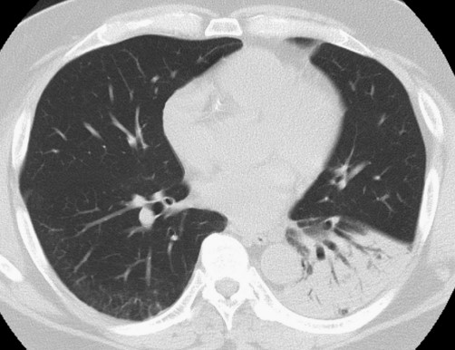 52歲男性持續(xù)咳嗽一個月，竟是感染了這種真菌︱病例學(xué)習(xí)