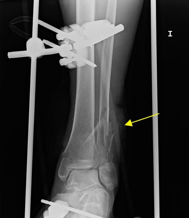 骨折后呼吸困難，警惕肺脂肪栓塞︱病例分享