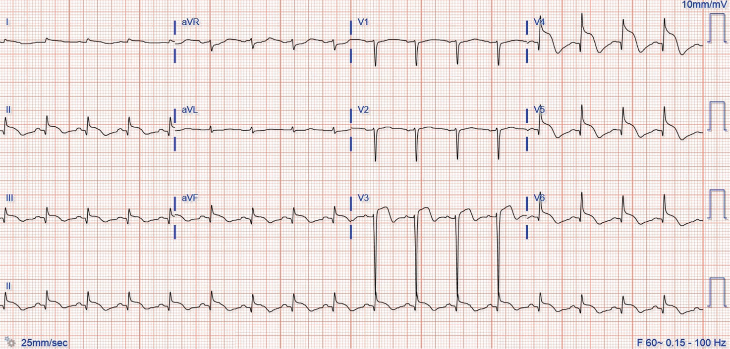 挑戰心電圖：這種特殊的ST段抬高，你認識嗎？