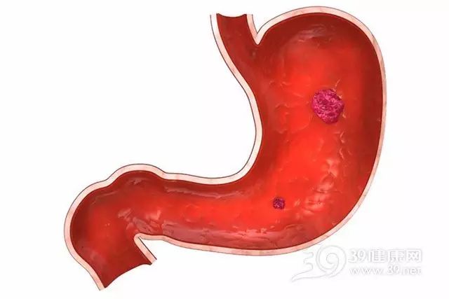 這種胃痛，是胃癌來臨的預報！