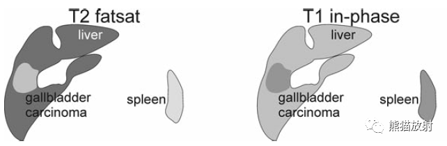 膽囊癌丨MRI表現(xiàn)（與膽囊壁水腫相鑒別）