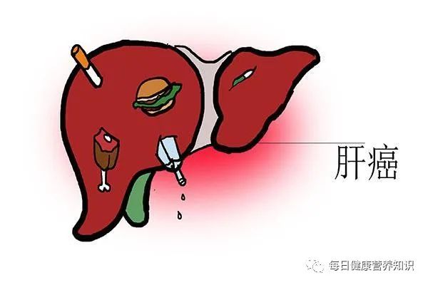 肝癌來臨，大小便先知？