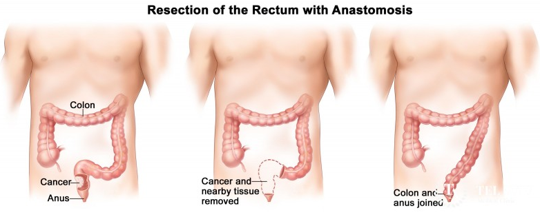 直腸癌怎么治療？如何在“保命”的基礎(chǔ)上實(shí)現(xiàn)“保肛”？