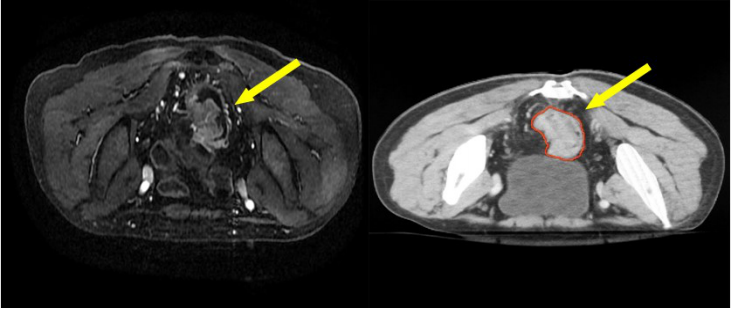 直腸癌的三維放療及調(diào)強(qiáng)放療靶區(qū)勾畫
